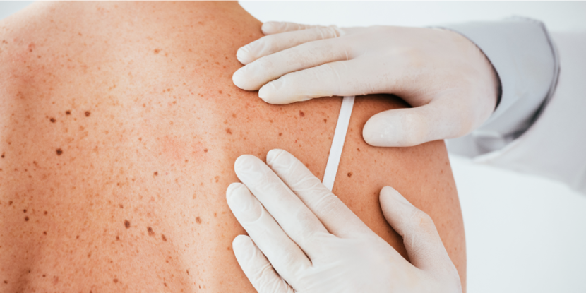 Free Skin Cancer Screening