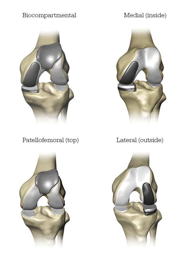 Mako partial knee implants