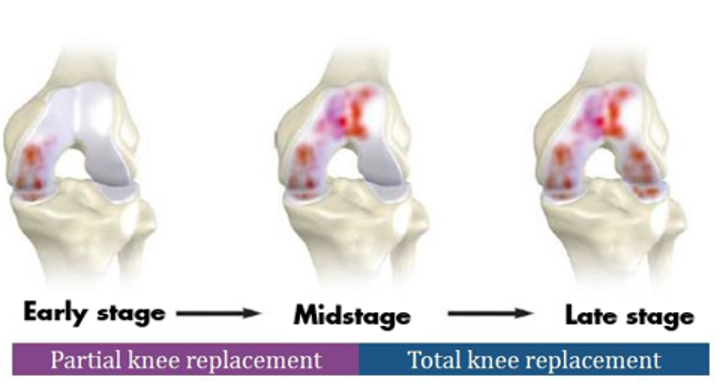 knee stages