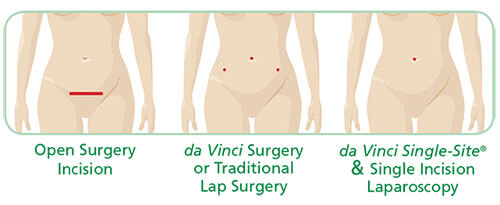 Single Site Hysterectomy