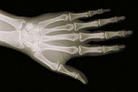 X-ray image of hand