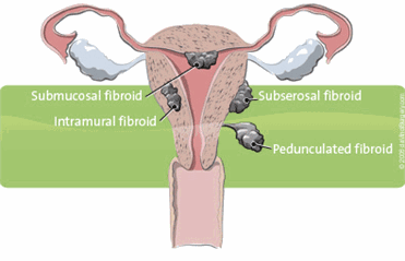 Fibroids